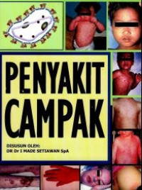 Image of penyakit campak