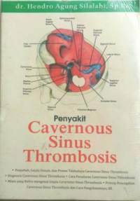 Image of penyakit cavernous sinus thrombosis